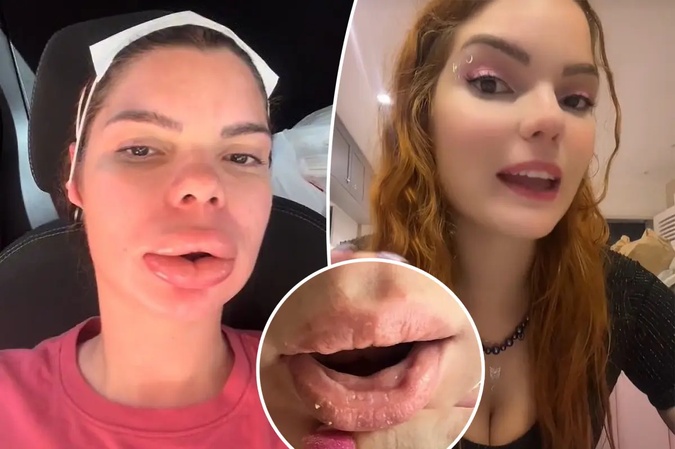 lip fillers before and after