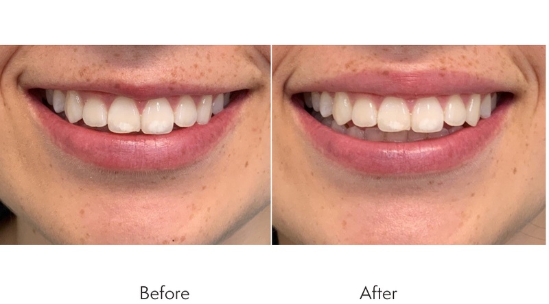 lip injection pics before and after