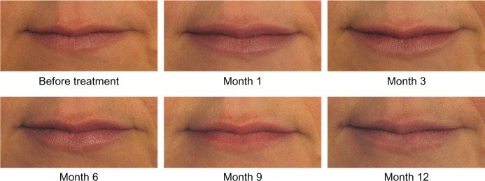 lip injections at 40 before and after pics