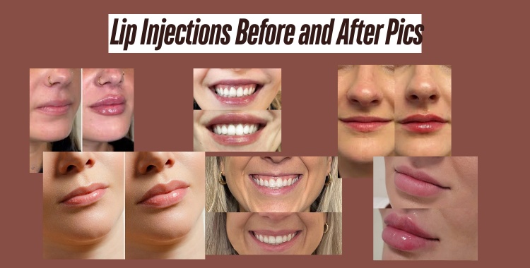 lip injections before and after