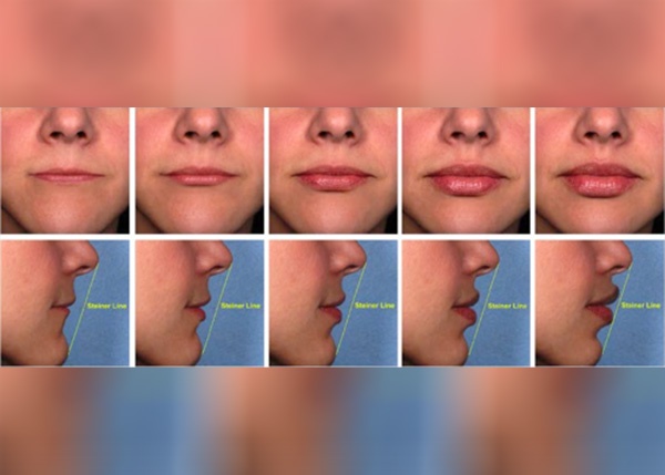 lips injection results