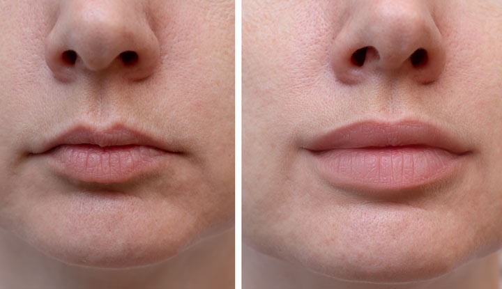 Ai Enhances Lips Naturally