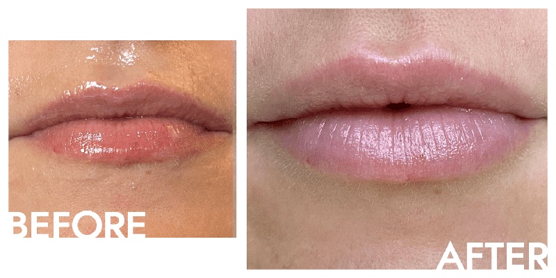 Uneven Lip Filler Ruins Natural Balance
